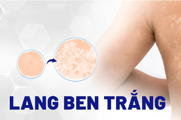 Lang ben là gì?